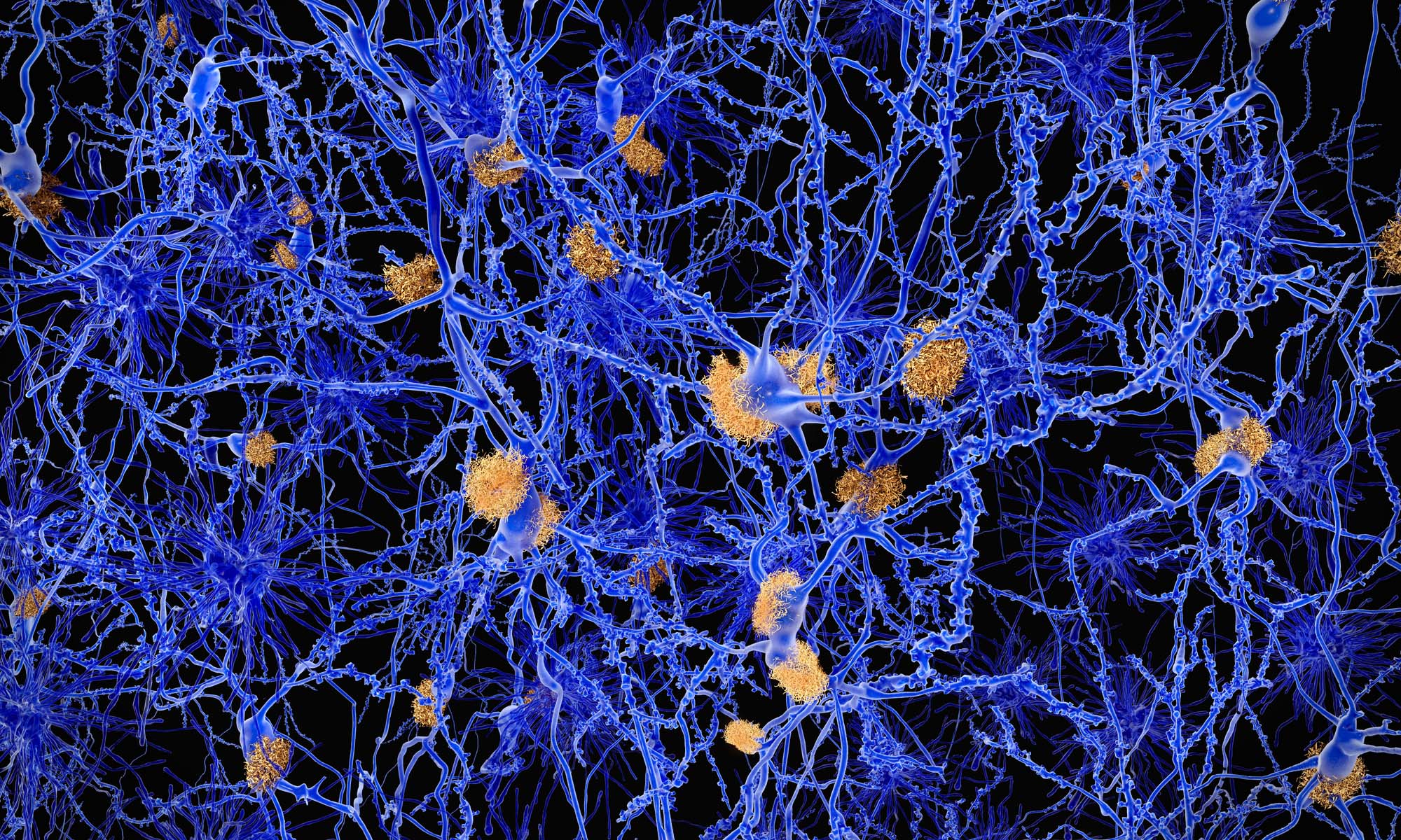 Image showing neurons with amyloid plaques.