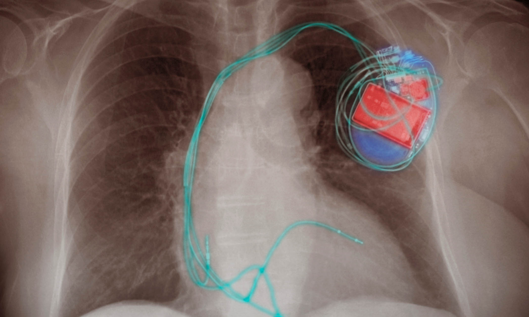 X-ray image showing a pacemaker and a patient's chest