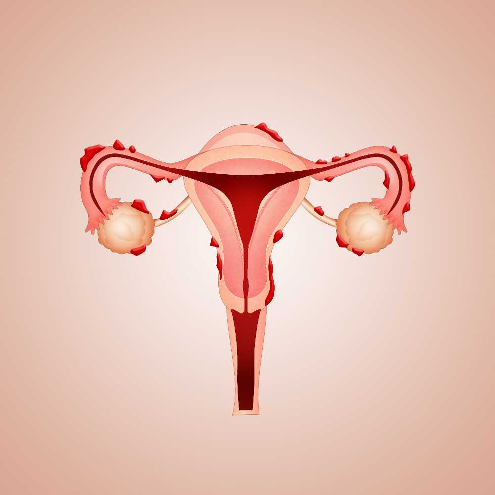 uterus with endometriosis