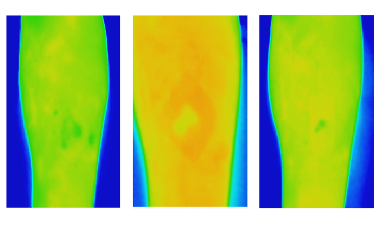 Three thermal images of a venous leg ulcer showing healthy healing progress over three weeks.