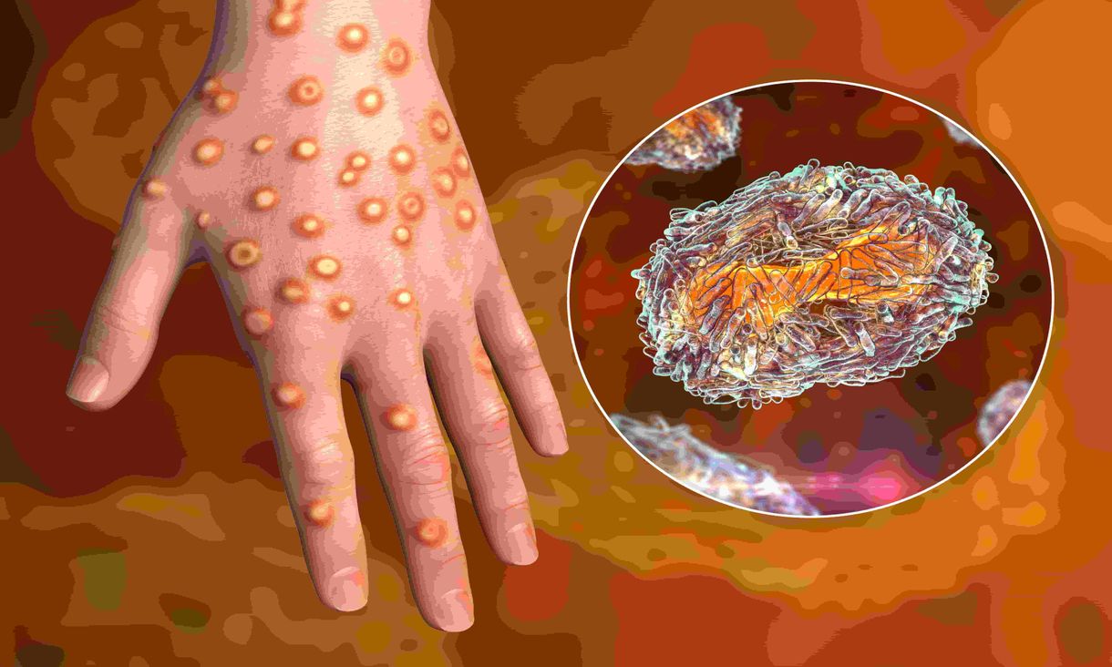 Hand with spots and close up of monkeypox virus