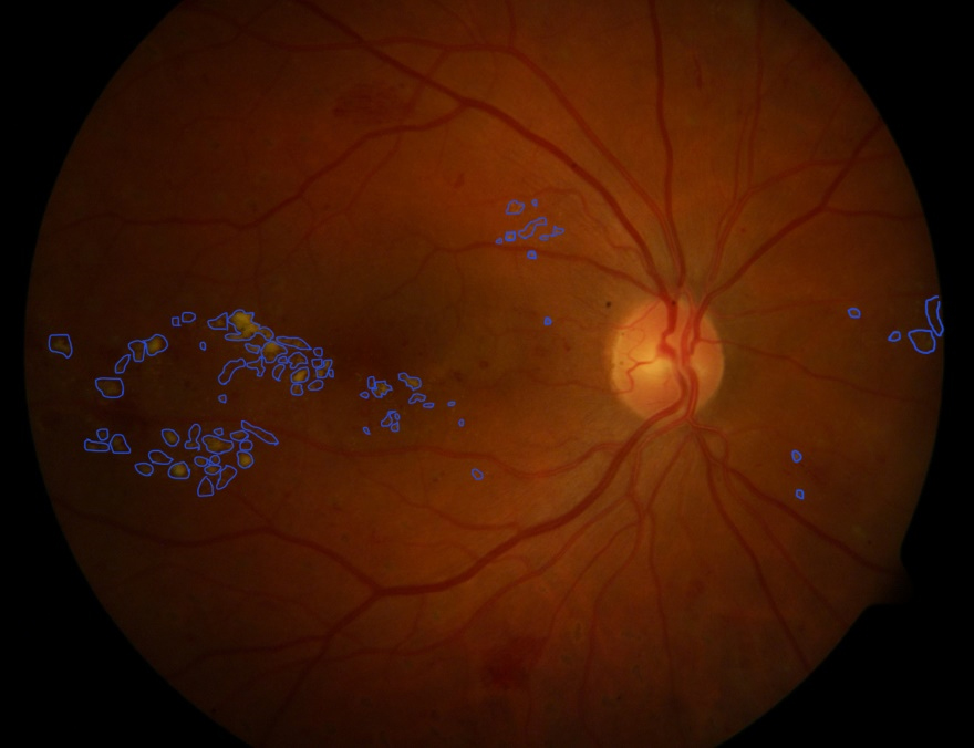 fundus image of a retina