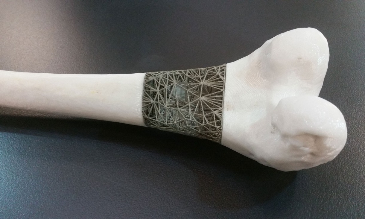 3d-printed bone implant.