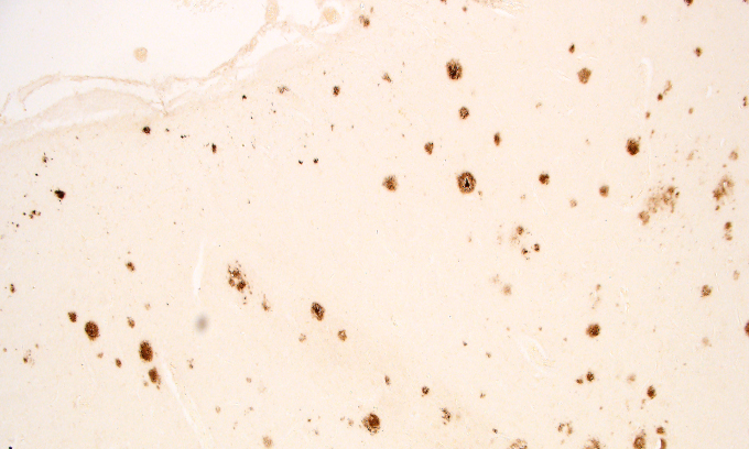 Microscope image of amyloid plaques in brain tissue.