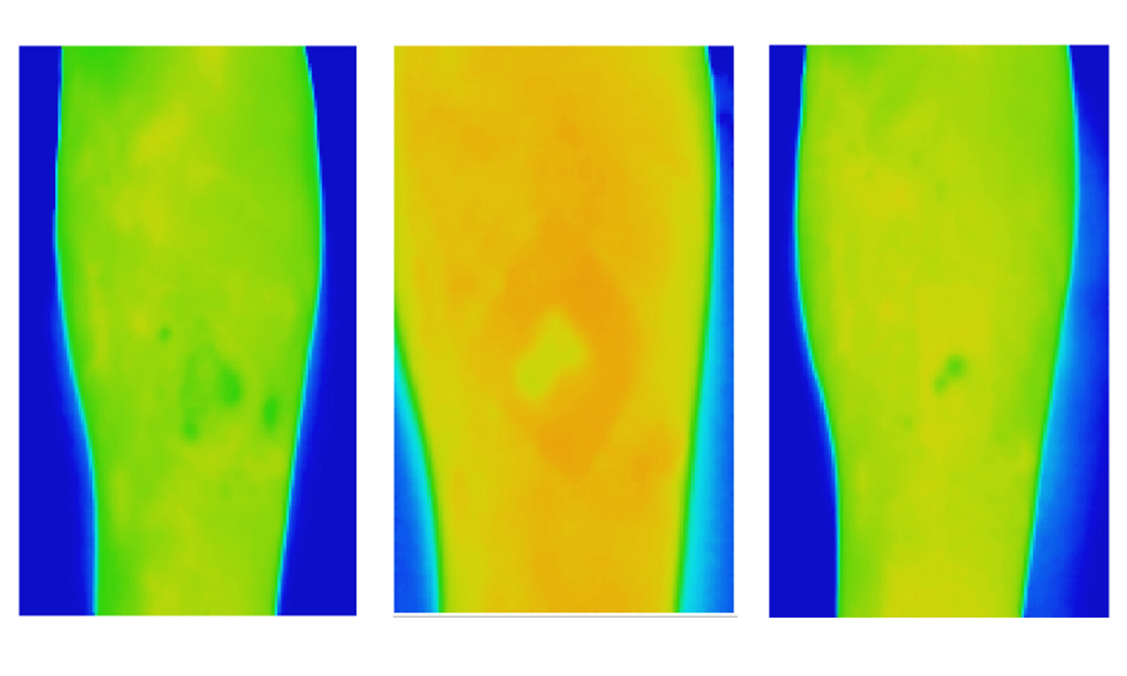 Three thermal images of a venous leg ulcer showing healthy healing progress over three weeks. 