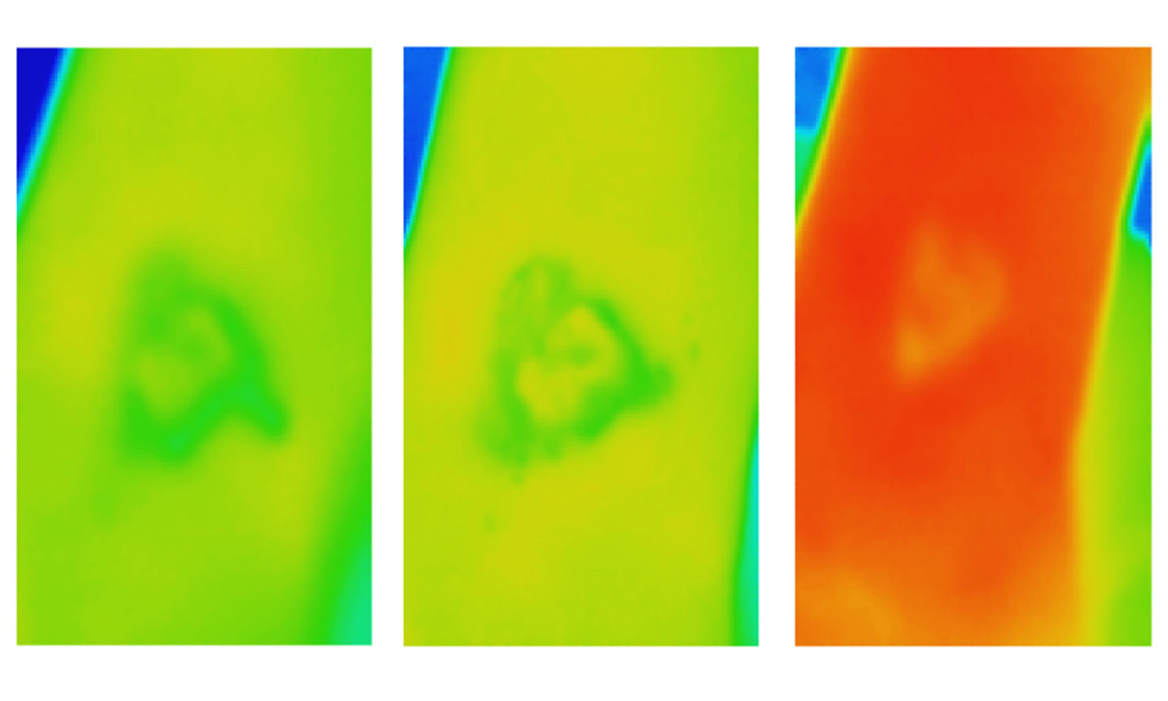 Thermal images of a venous leg ulcer that ultimately failed to heal. The images, taken over three weeks early in the healing process, can be used to predict that a VLU will not heal normally at week 12 and needs extra care.